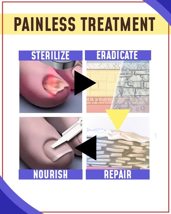 Set per trattamenti antifungini con luce blu - Image 2