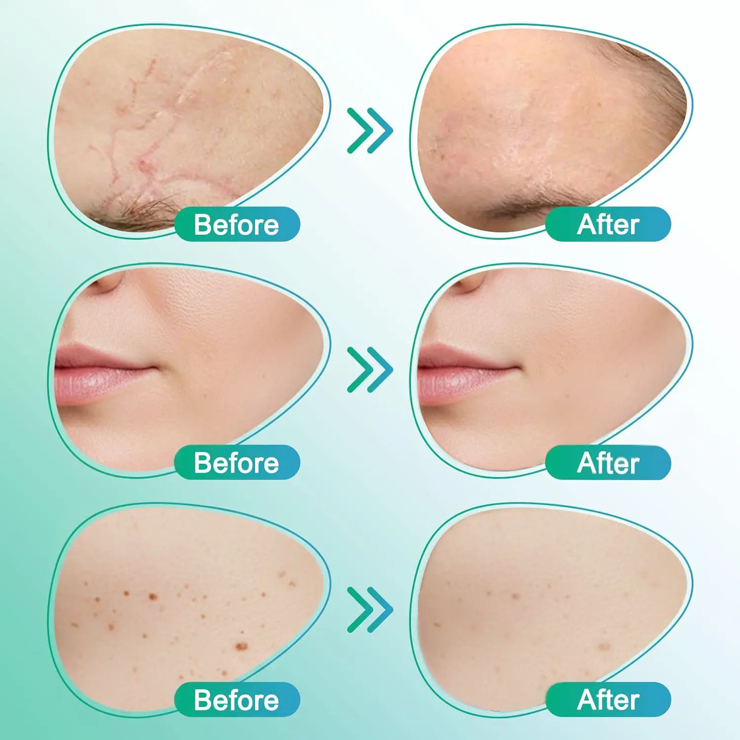 ๐๐ฎ๐ฟ๐ฒ๐๐ฟ๐ฒ๐ฒ๐๐ฒยฎ Patch per la cura dei microaghi 3 in 1 - Image 5