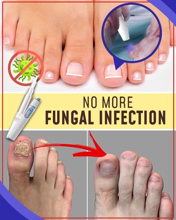 Set per trattamenti antifungini con luce blu - Image 3