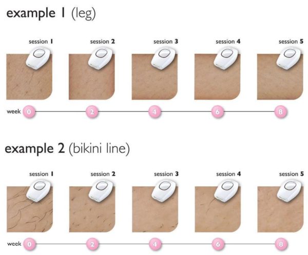 Sistema di depilazione IPL - Image 5