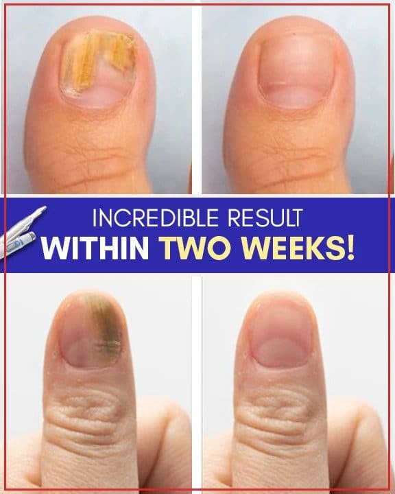 Set per trattamenti antifungini con luce blu - Image 5