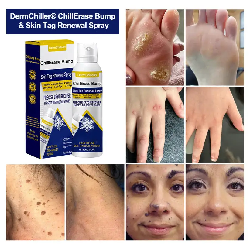 DermChiller® ChillErase Spray per il rinnovamento di protuberanze ed etichette cutanee - Image 2