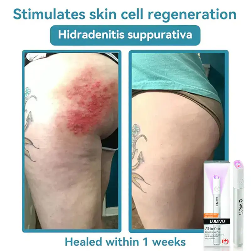 Penna cancellatrice laser a CO₂ tutto in uno LUMIVO™ - Image 12